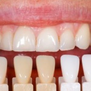 smile, beauty, teeth,